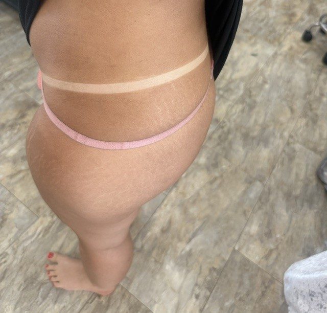 Bikini tan lines
